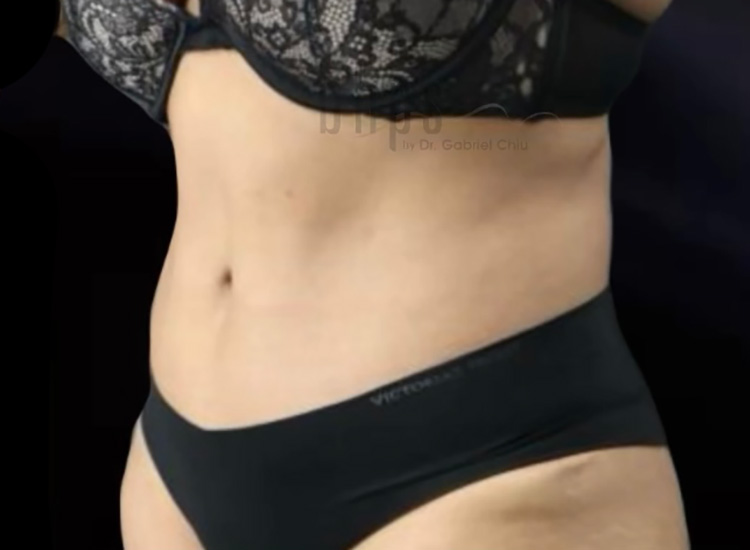 Case--1286 | After Liposuction 2