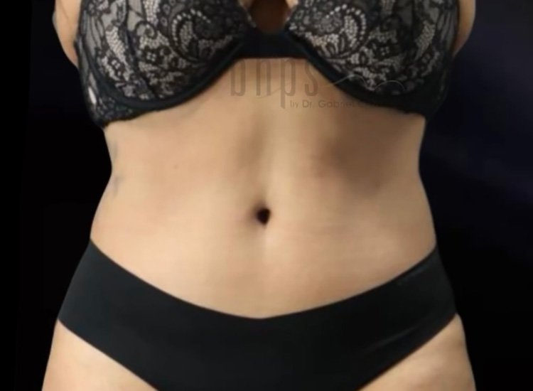 Case--1286 | After Body