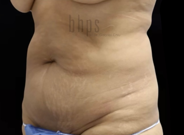 Case--1286 | Before Liposuction 2