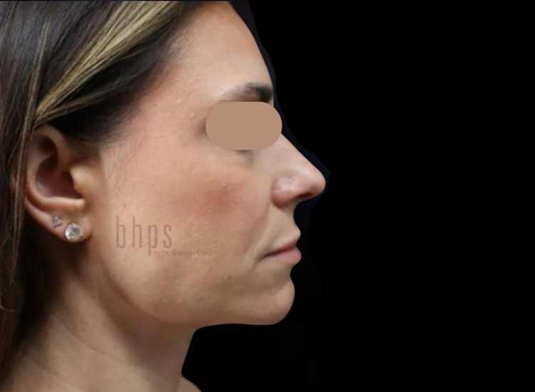 Case--5757 | After Liposuction 2