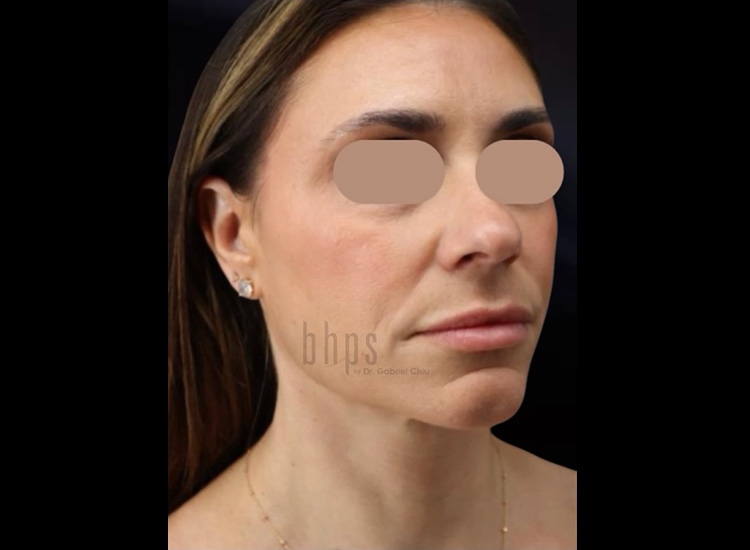 Case--5757 | After Liposuction