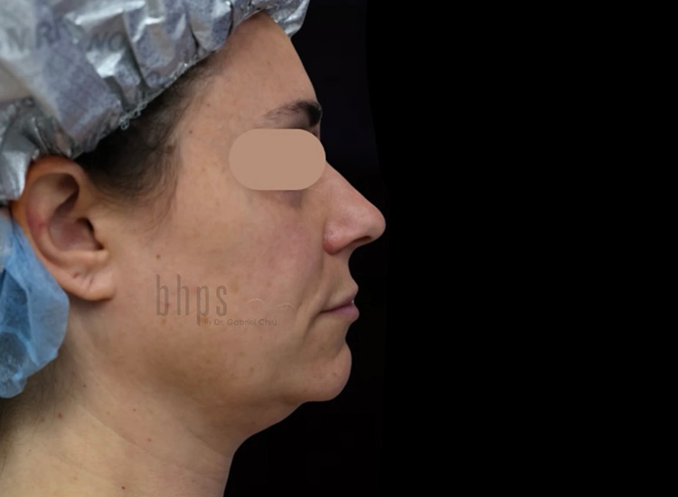 Case--5757 | Before Liposuction 2