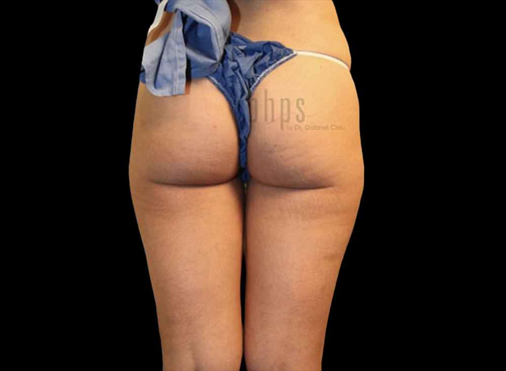 Case--2458 | Before Body