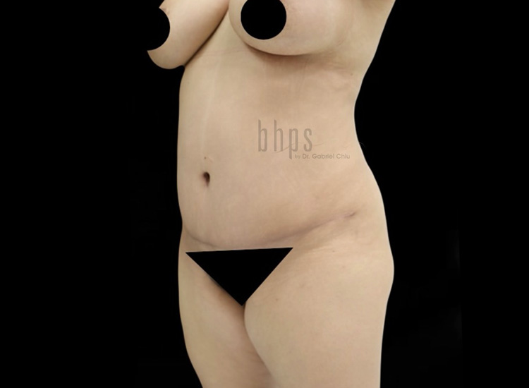 Case--7005 | After Liposuction 2