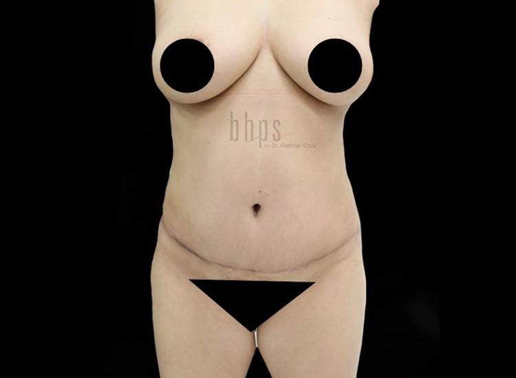 Liposuction Patient After - 2
