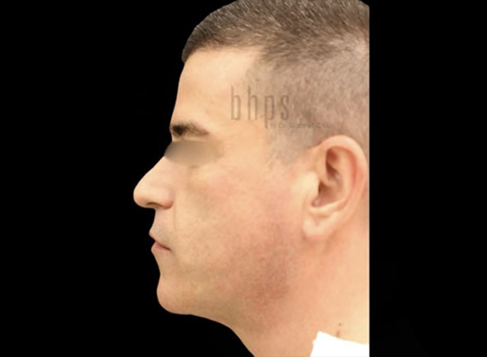 Case--5301 | After Liposuction 2