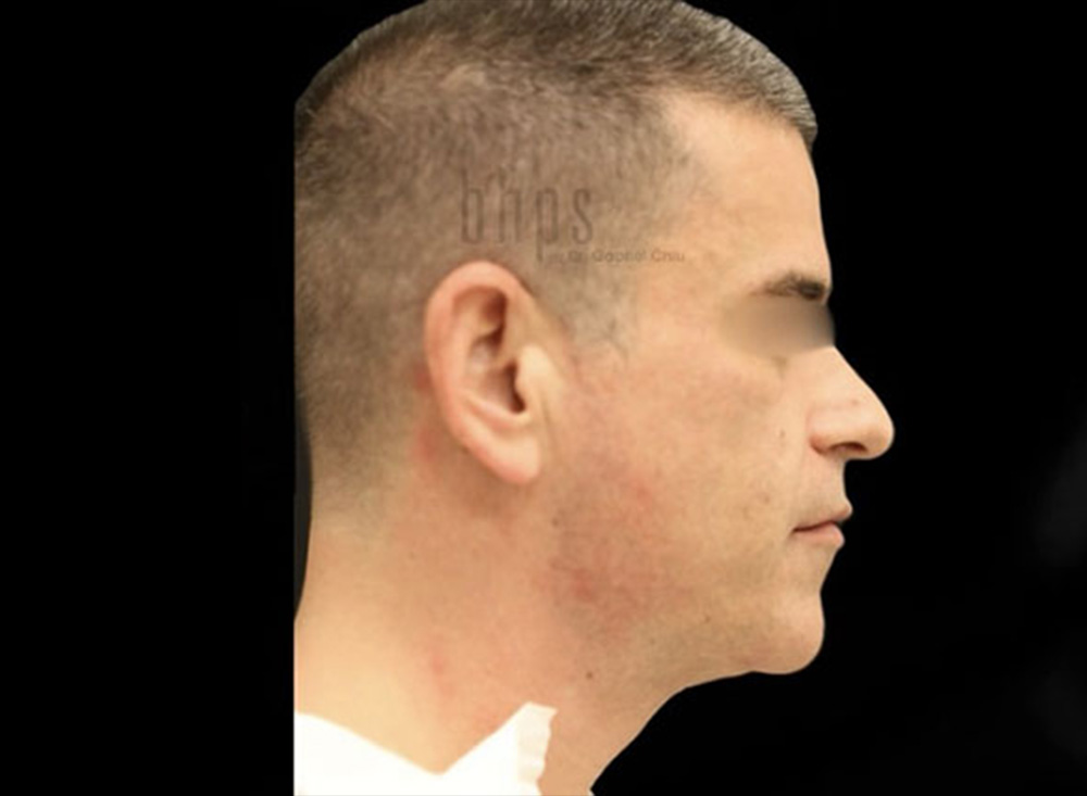 Case--5301 | After Body