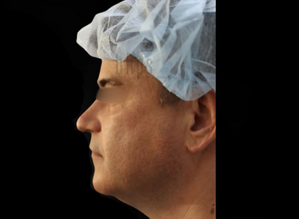 Case--5301 | Before Liposuction 2