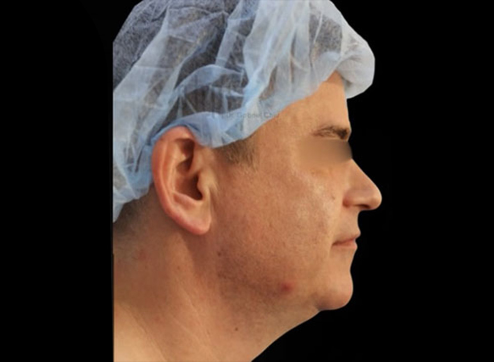 Case--5301 | Before Body