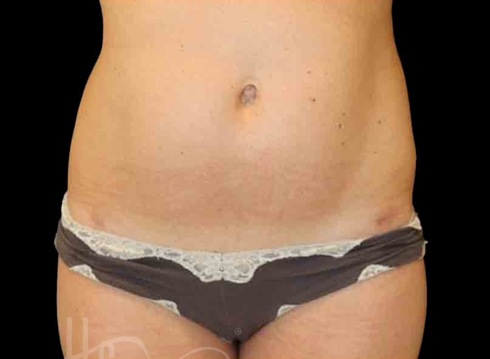 Case--8034 | After Body