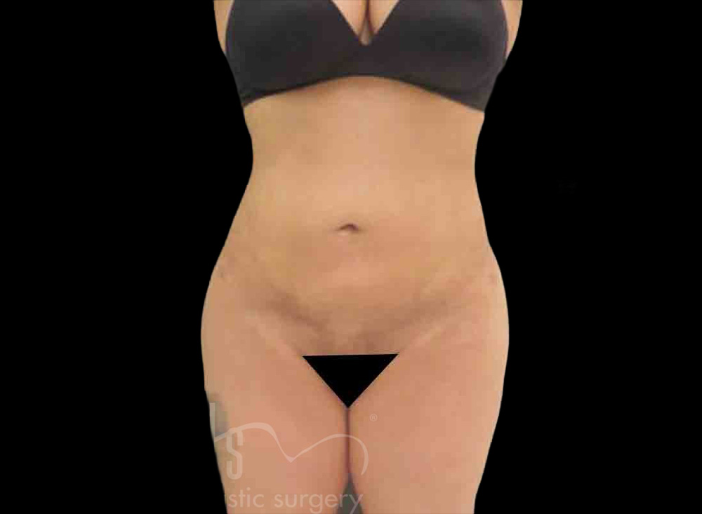 Case--4652 | After Body