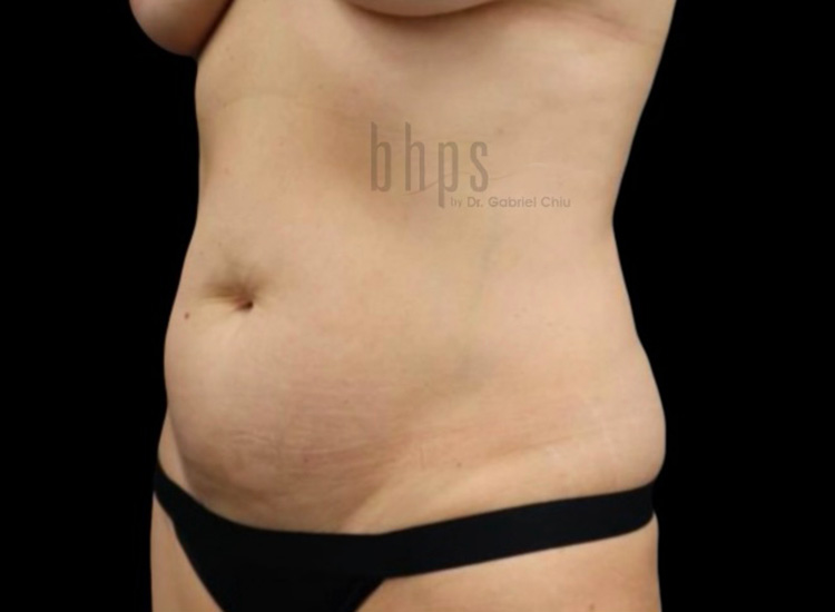 Case--7038 | Before Liposuction 2