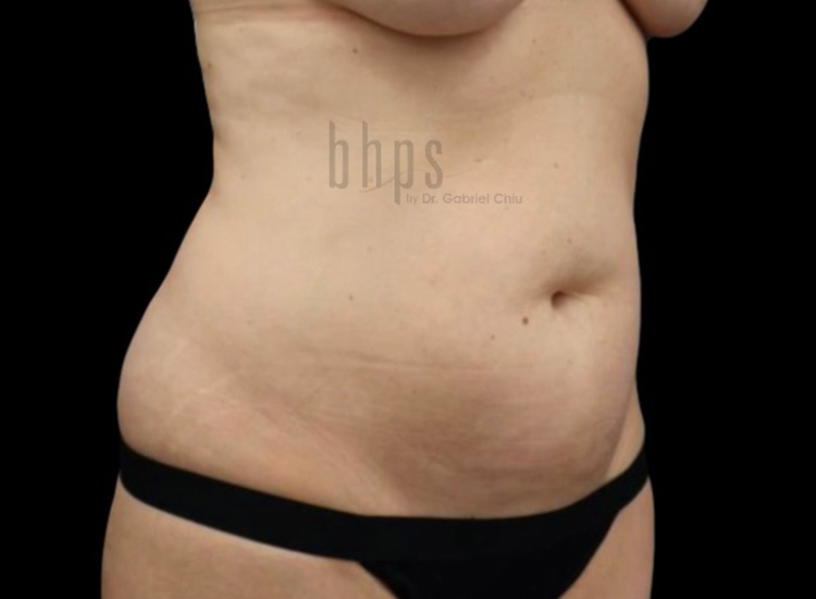 Case--7038 | Before Liposuction 3