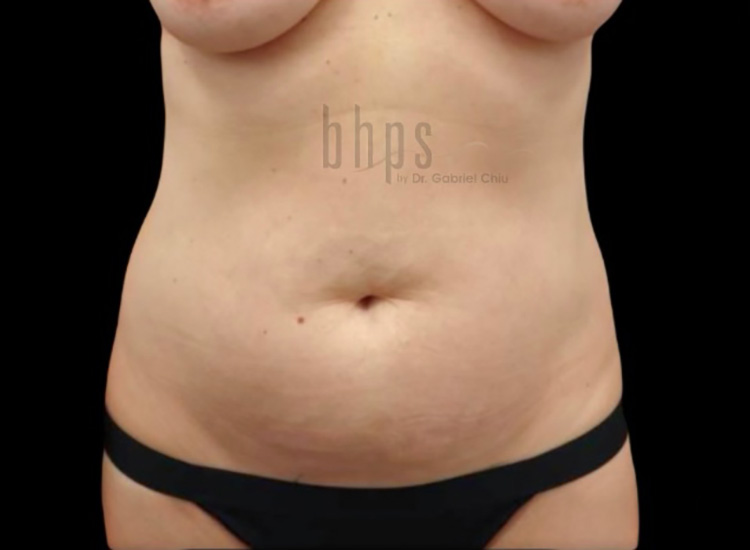 Case--7038 | Before Body