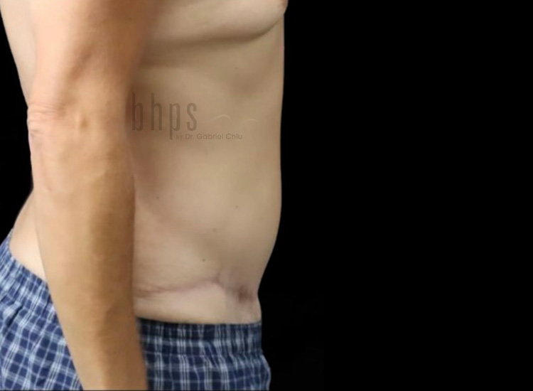 Case--4815 | After Body