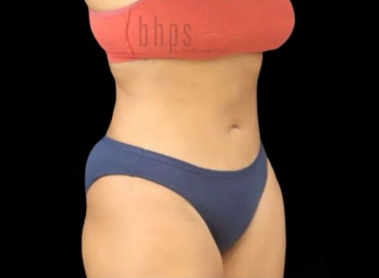 Liposuction Patient After - 1