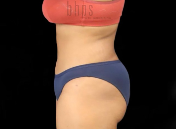 Case--8644 | After Liposuction 3