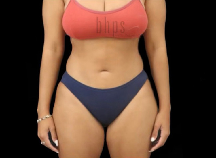 Case--8644 | After Body