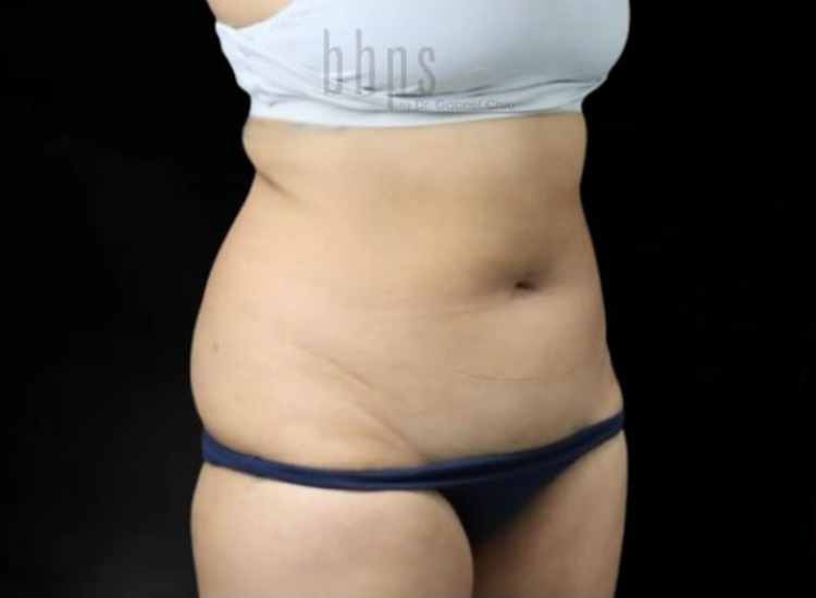 Liposuction Patient Before - 1