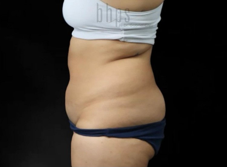 Case--8644 | Before Liposuction 3