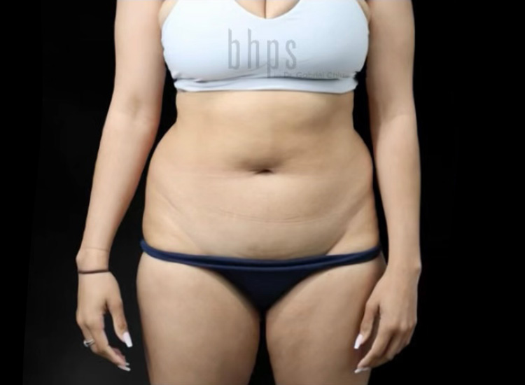 Case--8644 | Before Body