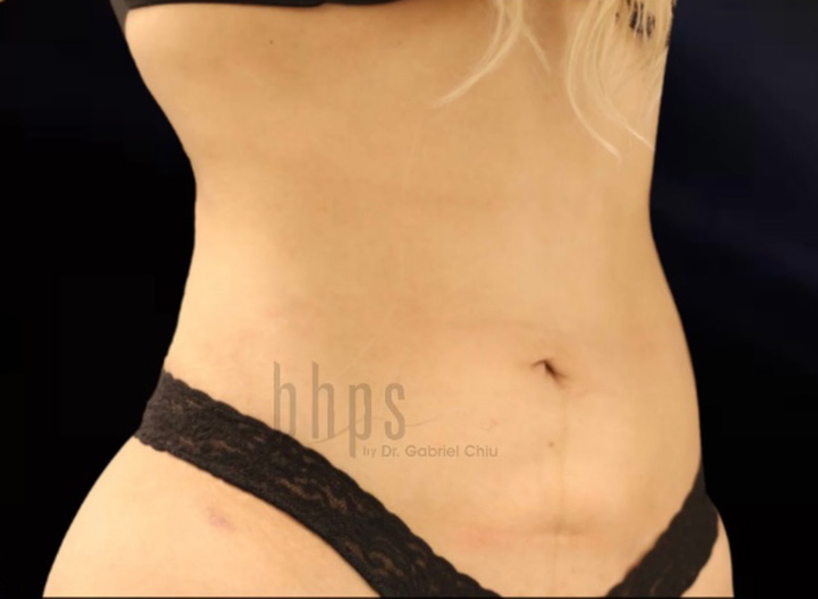 Case--3342 | After Liposuction 2