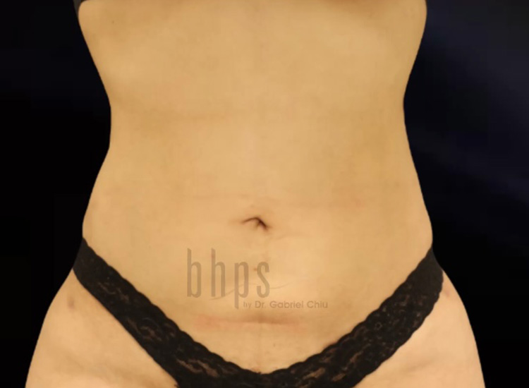 Case--3342 | After Liposuction