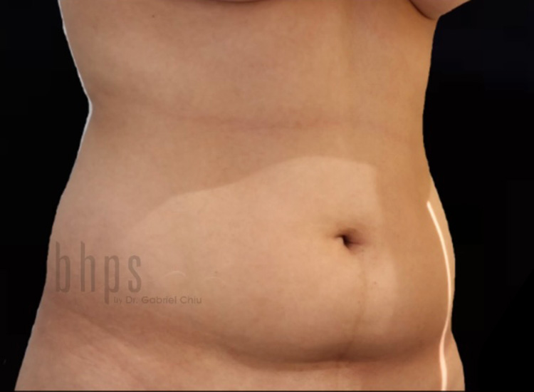 Case--3342 | Before Liposuction 2