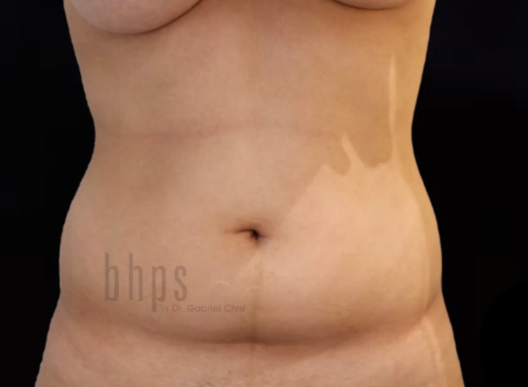 Case--3342 | Before Liposuction