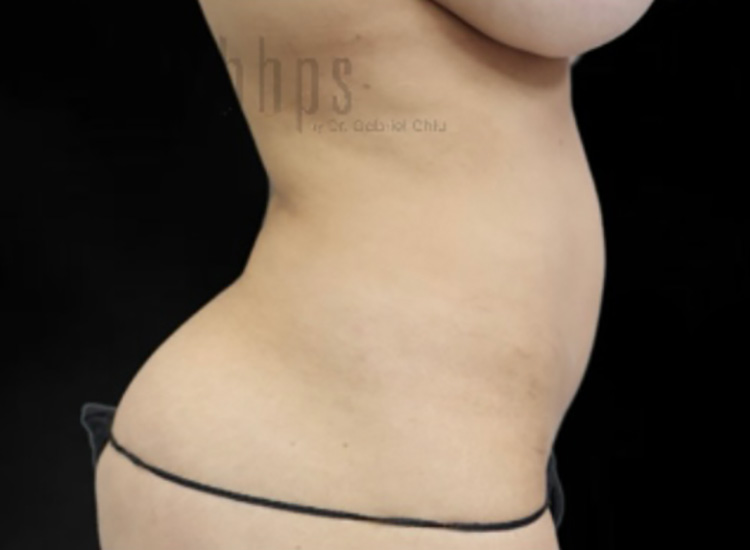 Case--4628 | Before Liposuction