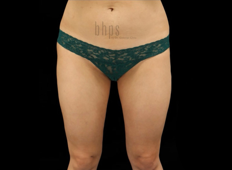 Case--4629 | After Liposuction