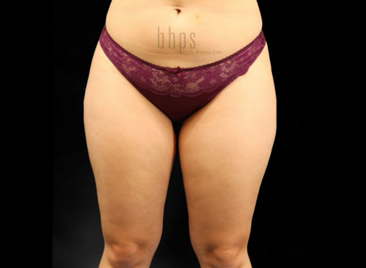 Case--4629 | Before Liposuction