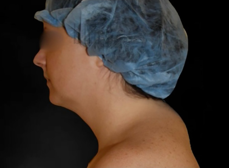 Case--9244 | Before Liposuction