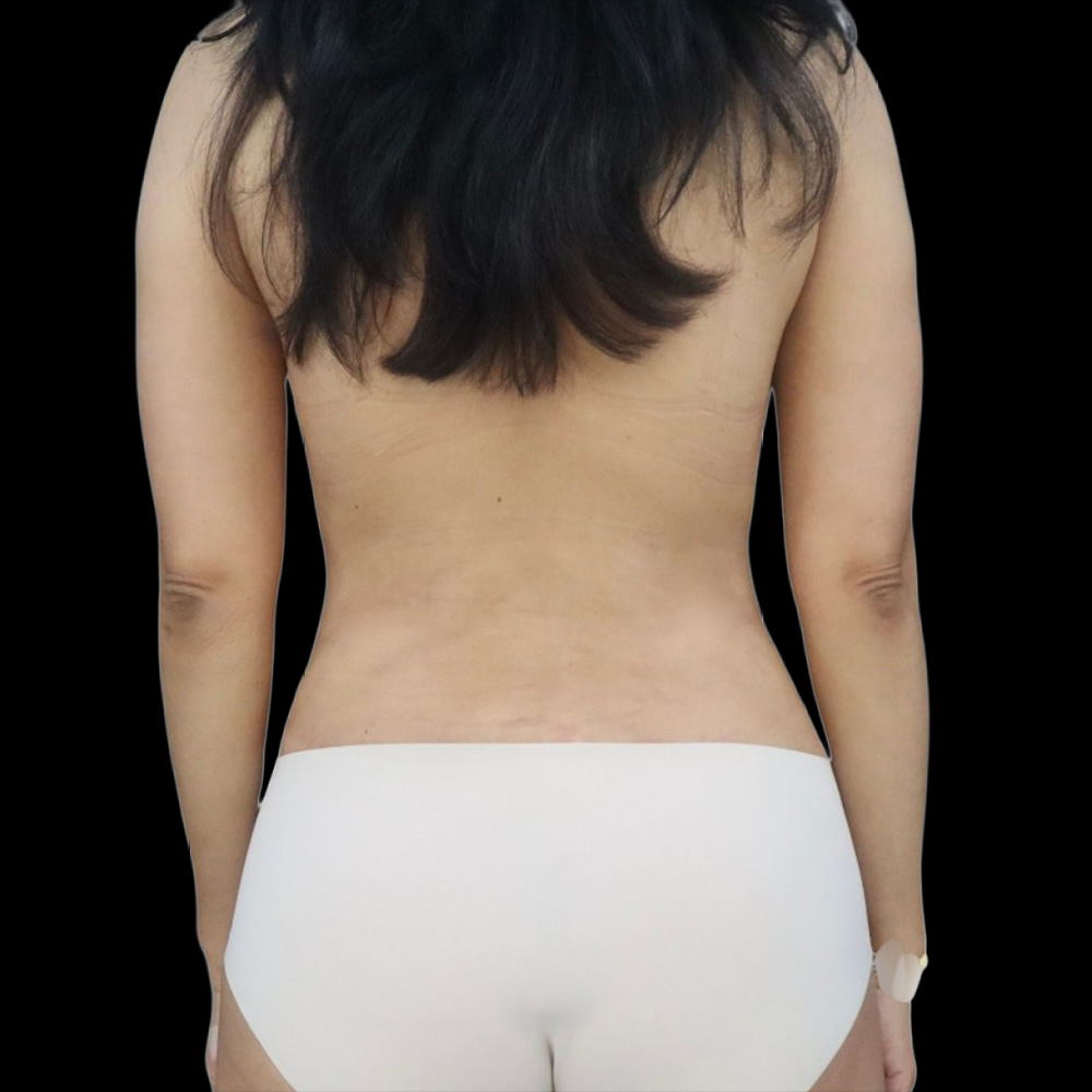 Case--6622 | After Liposuction with Fat Transfer to the Breasts 2