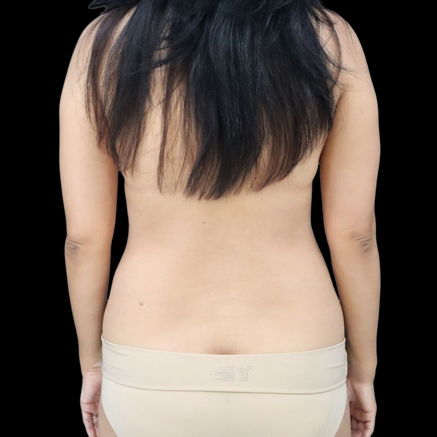 Case--6622 | Before Liposuction with Fat Transfer to the Breasts 2