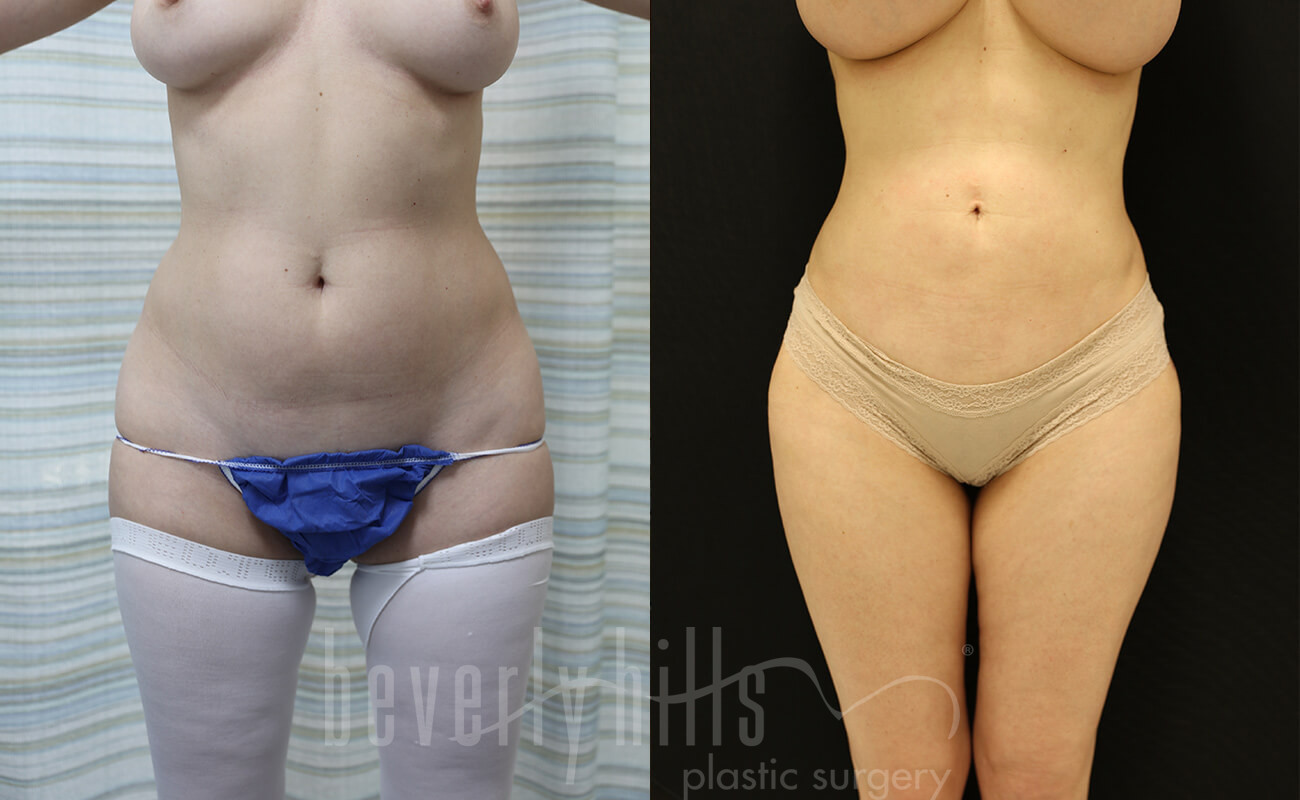 Liposuction Patient 41 Before & After