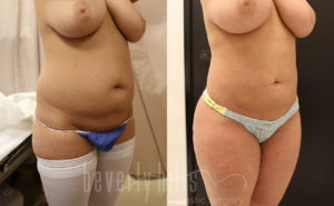 Liposuction Patient 42 Before & After - Thumbnail