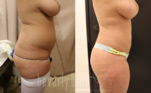 Liposuction Patient 42 Before & After - Thumbnail