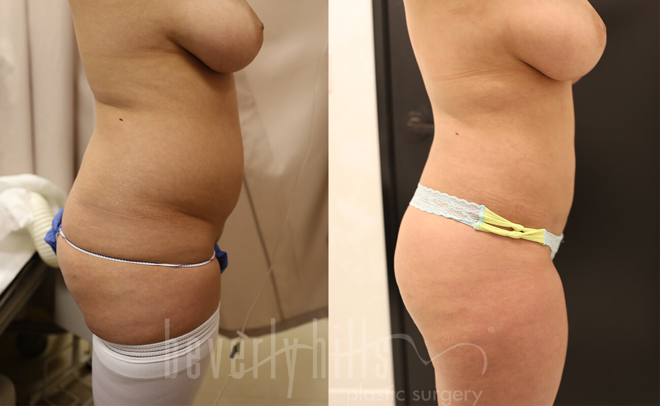 Liposuction Patient 42 Before & After