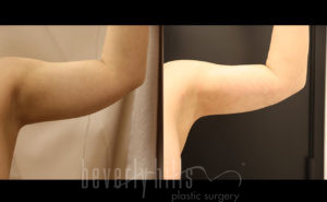 Liposuction Patient 42 Before & After - Thumbnail