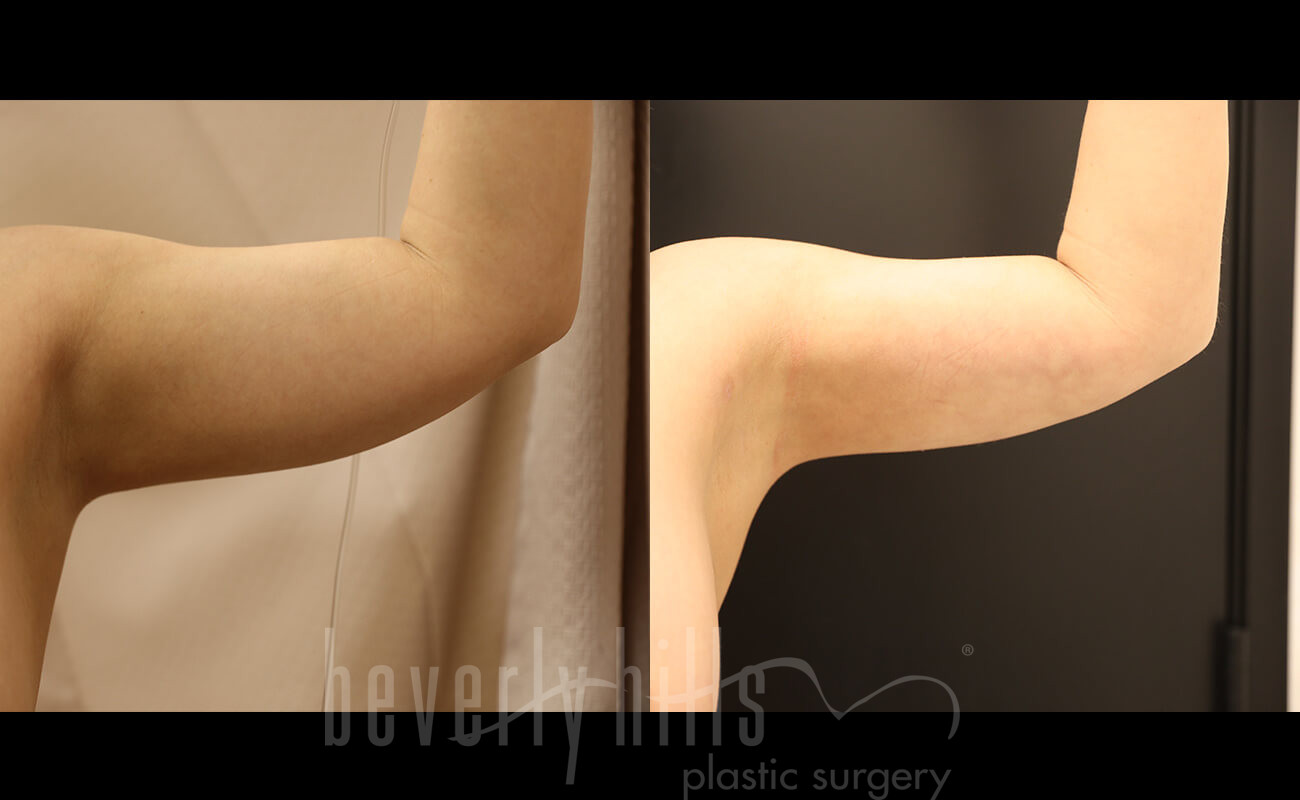 Liposuction Patient 42 Before & After