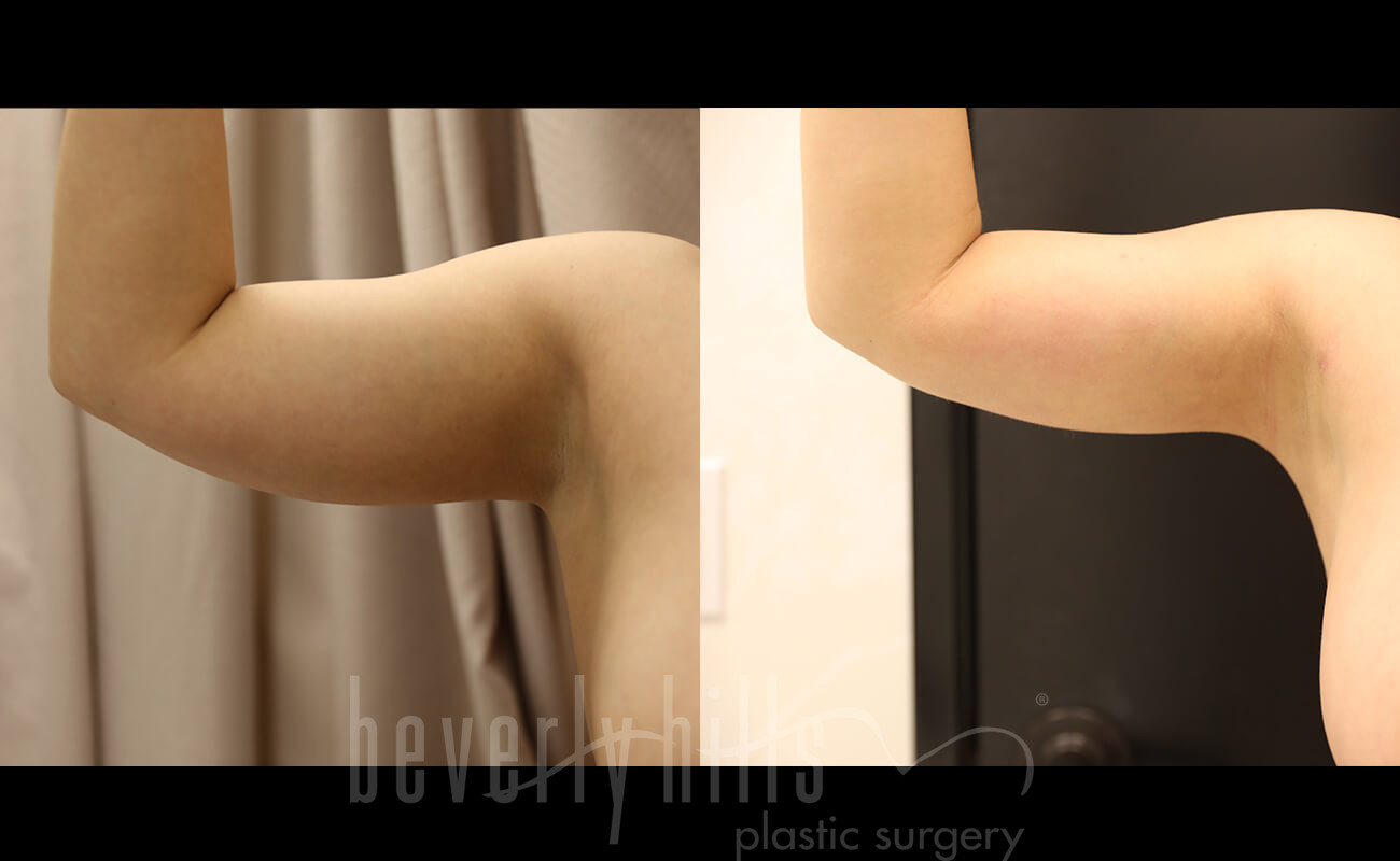 Liposuction Patient 42 Before & After