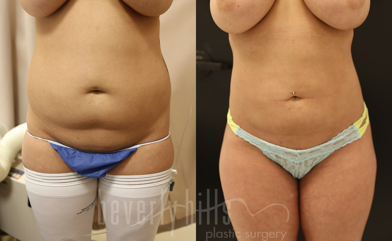 Liposuction Patient 42 Before & After