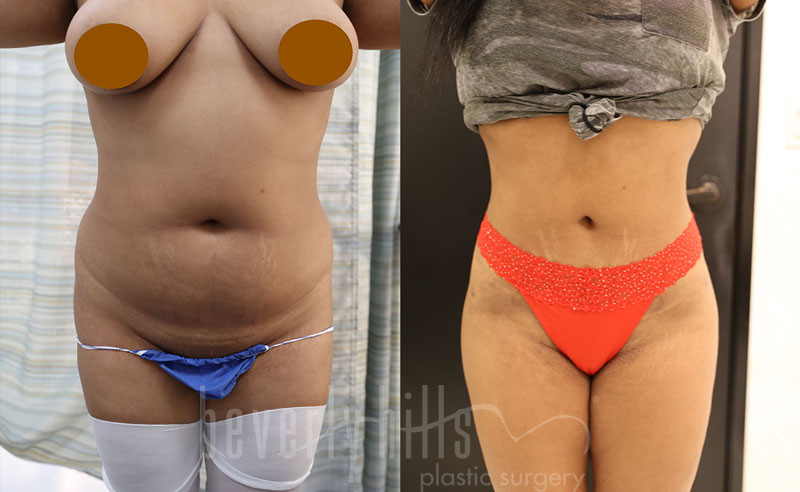 LIPOSUCTION PATIENT 43 Before & After