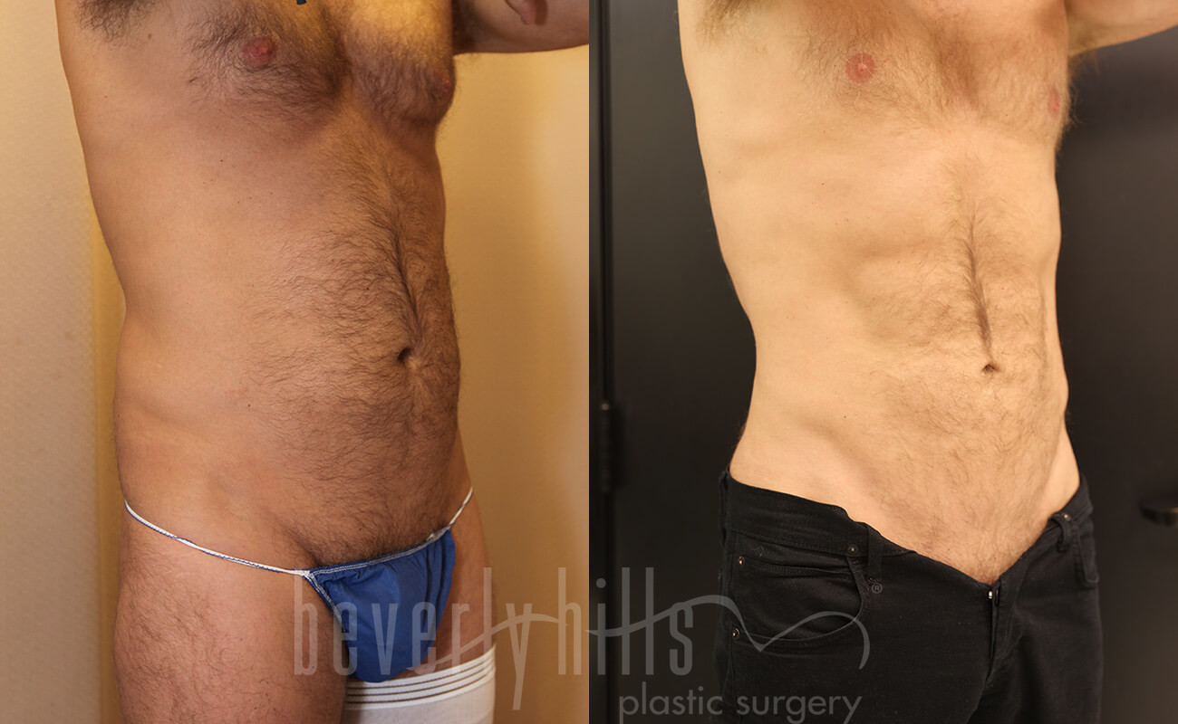 Abdominal Etching/Male Liposuction Patient 07 Before & After