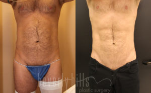 Abdominal Etching/Male Liposuction Patient 07 Before & After - Thumbnail