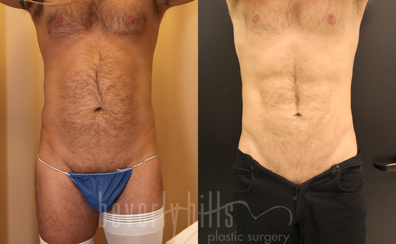 Abdominal Etching/Male Liposuction Patient 07 Before & After