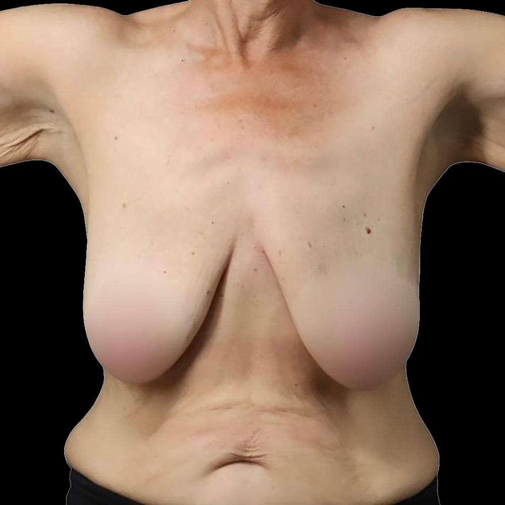 Case--9105 | Before Mastopexy