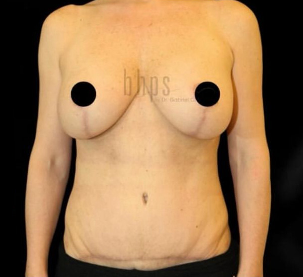 Mommy Makeover Patient After - 1