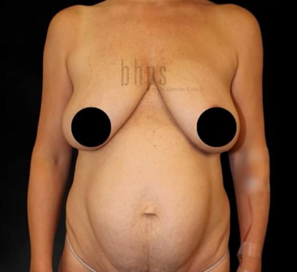 Mommy Makeover Patient Before - 1